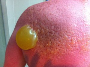 Severe sunburn first aid